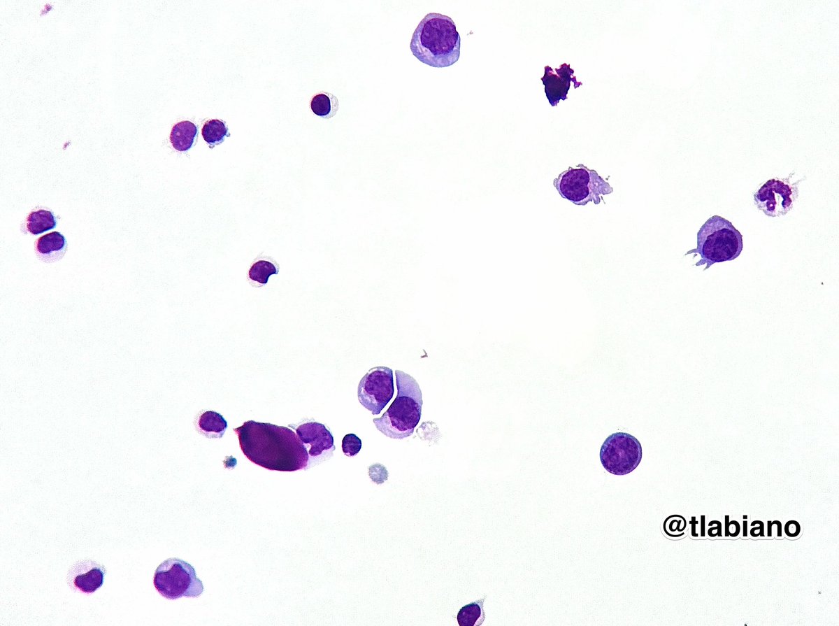 tlabiano's tweet photo. 🧠💧Cerebrospinal fluid #CSF #cytology 🔬Large cells w/  pleomorphic population of lymphoid cells with irregular nuclear contours. 
📋✍🏼Patient has history of Diffuse large B-cell lymphoma.
#giemsa  #cytopath https://t.co/MEqkQ4fPht