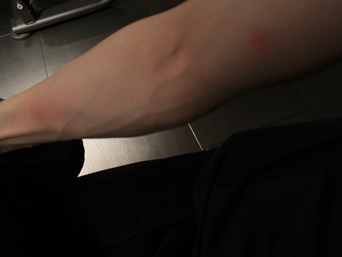 a2b1popbase's tweet photo. AND2BLE's Ricky reports being bitten by mosquitoes 5 times on his arm in recent Bubble chat. https://t.co/NpDhahM683