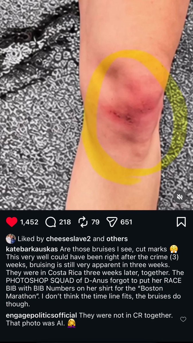 KendallSals's tweet photo. Are these battle wounds from fighting and killing literal children? https://t.co/sRoFfQKHxc