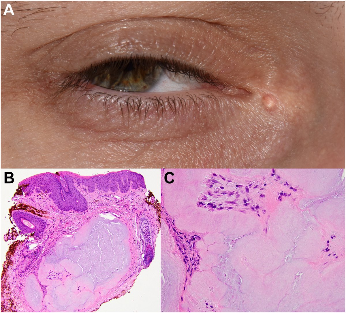 AAOjournal's tweet photo. A 33-year-old man with a known history of gout presented with a 1-year history of a growing right medial canthus lesion. Examination revealed a 1.5-mm subepidermal nodule overlying the medial canthal tendon (A), initially suspected to be an epidermal inclusion cyst. Excision and histopathologic analysis confirmed a gouty tophus, demonstrating feathery clefts from dissolved urate crystals and multinucleated histiocytes (B and C, hematoxylin and eosin staining, 10× and 40×, respectively). The patient had never been on urate-lowering therapy. His most recent uric acid level was 6.6 mg/dL (reference range, 3.4–7.0 mg/dL). Periocular gouty tophi, although uncommon, should remain in the differential diagnosis of subepidermal periocular nodules, particularly in patients with a known history of gout. 
https://t.co/Rqn2HZLfFK
#ophthalmology
