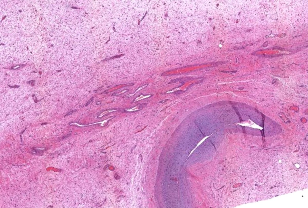 JMGardnerMD's tweet photo. 35 yo woman with vulvar mass. 15cm &amp; infiltrative on CT.
digital slide: https://t.co/s9GDKrNZYe.
Answer ✅ https://t.co/23V32QVtNb
#pathology #BSTpath #pathologists #pathTwitter #gynpath #dermpath https://t.co/tP5Nb4gBL7