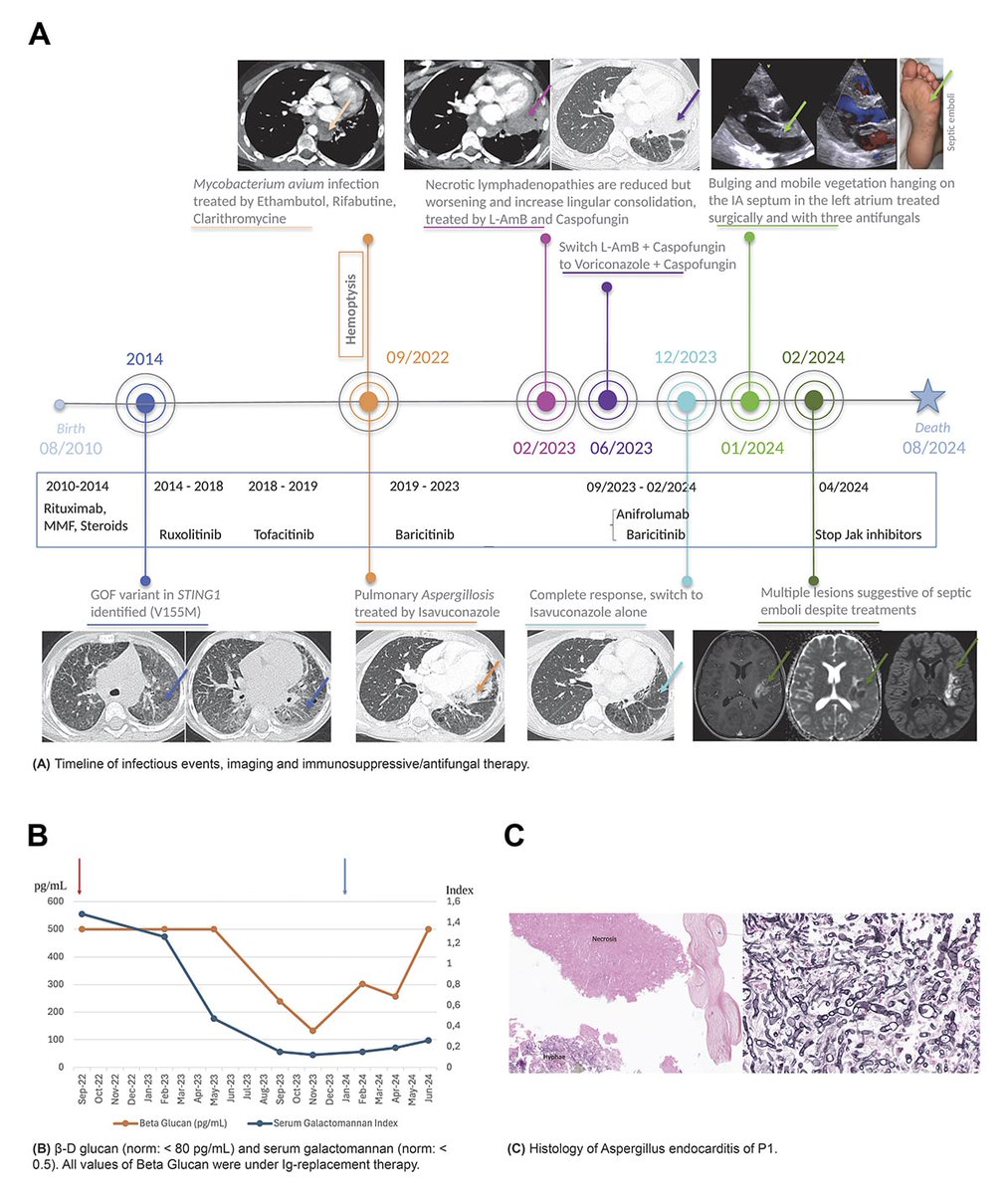 jhumimmunity's tweet photo. Dethier et al. describe a young girl w/ SAVI on prolonged JAK inhibitors who developed fatal Aspergillus endocarditis. They illustrate the major therapeutic challenges in STING1 gain-of-function disorders due to their intrinsic immunological abnormalities. https://t.co/zafKATvxEK https://t.co/MS6nX0zJi0