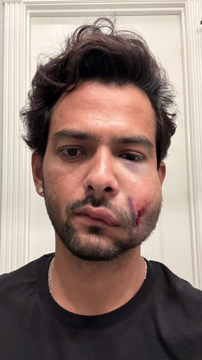 UnmuktChand9's tweet photo. The face has seen some damage over the years. 😅

A broken jaw. A swollen eye. And now this.

A day after scoring a hundred, an on-field collision while taking a catch. Thankfully, no fracture. 🙏

That’s sport. Things change in a second.

Get back up. Go again. No stopping. 🏏💪 https://t.co/c0YDeLDVVA