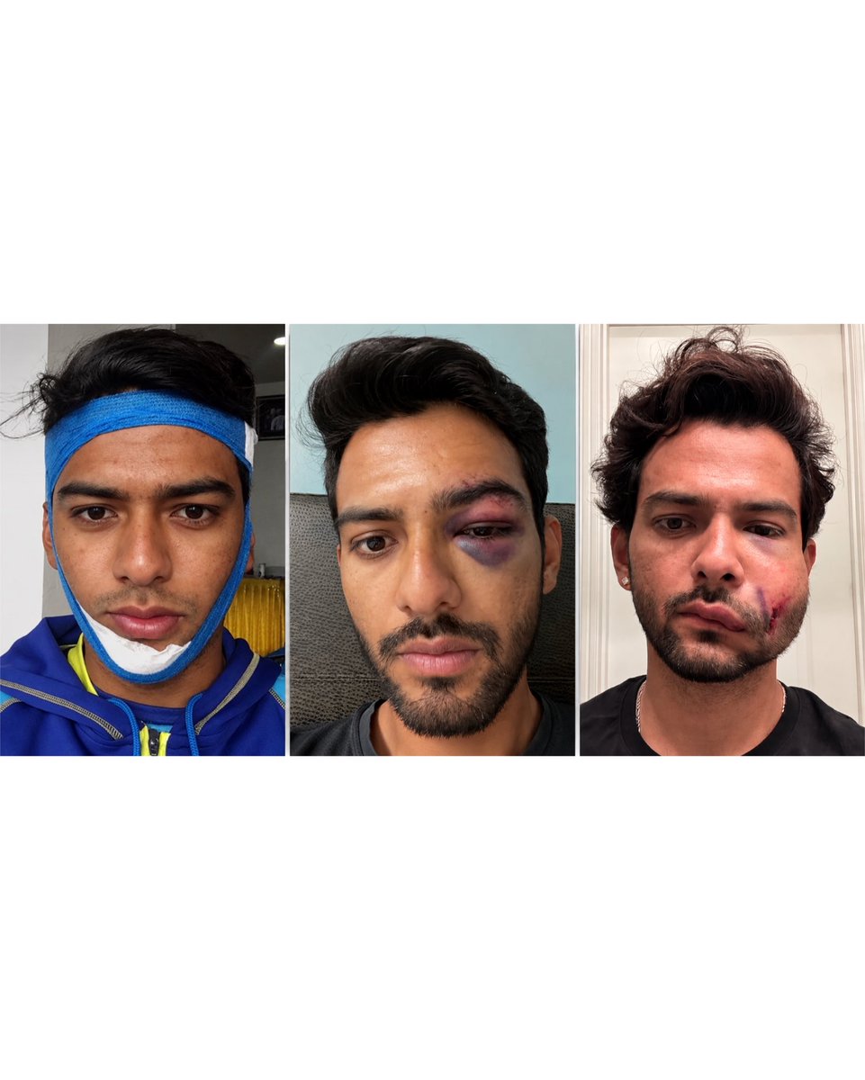 UnmuktChand9's tweet photo. The face has seen some damage over the years. 😅

A broken jaw. A swollen eye. And now this.

A day after scoring a hundred, an on-field collision while taking a catch. Thankfully, no fracture. 🙏

That’s sport. Things change in a second.

Get back up. Go again. No stopping. 🏏💪 https://t.co/c0YDeLDVVA