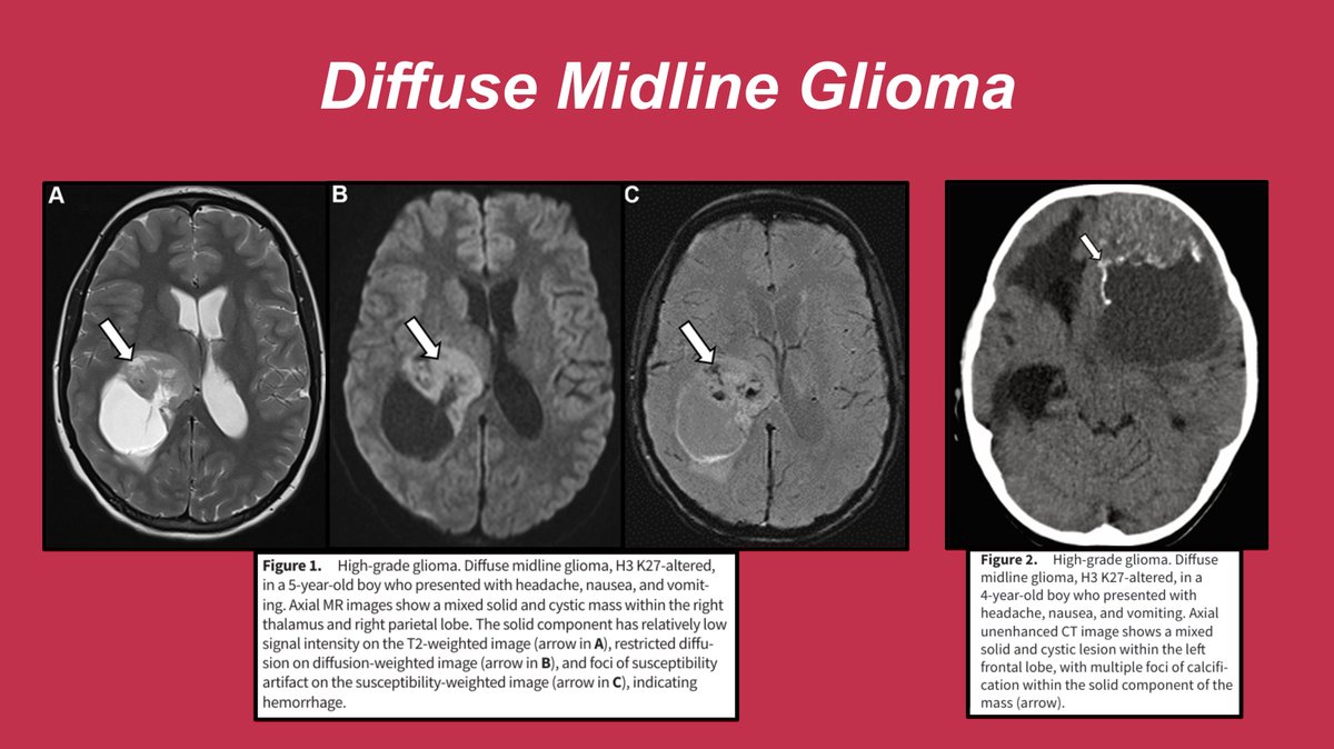 JamieClarkeRad's tweet photo. Now, let’s take a look at some examples of pediatric brain tumors with high-grade features, starting with diffuse midline glioma (Figures 1 &amp; 2).
#RGphx https://t.co/n4t0oj0Ork