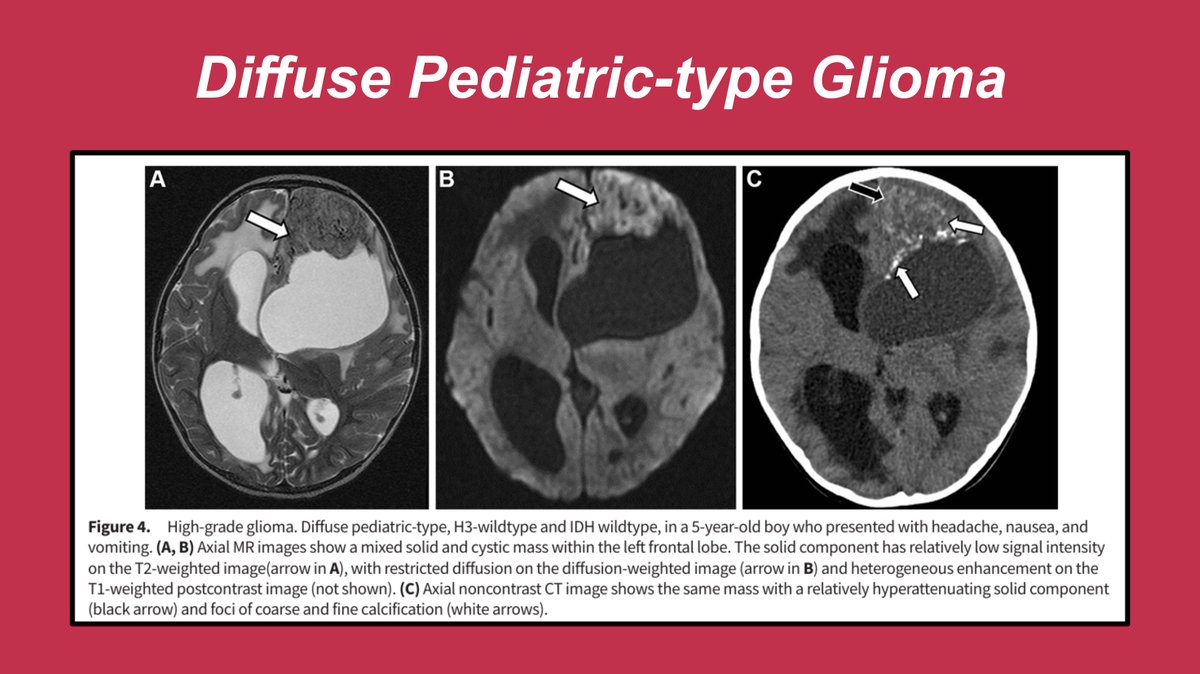 JamieClarkeRad's tweet photo. Now, let’s review a case of diffuse pediatric-type glioma (Figure 4).
#RGphx https://t.co/a1JllBnCbW