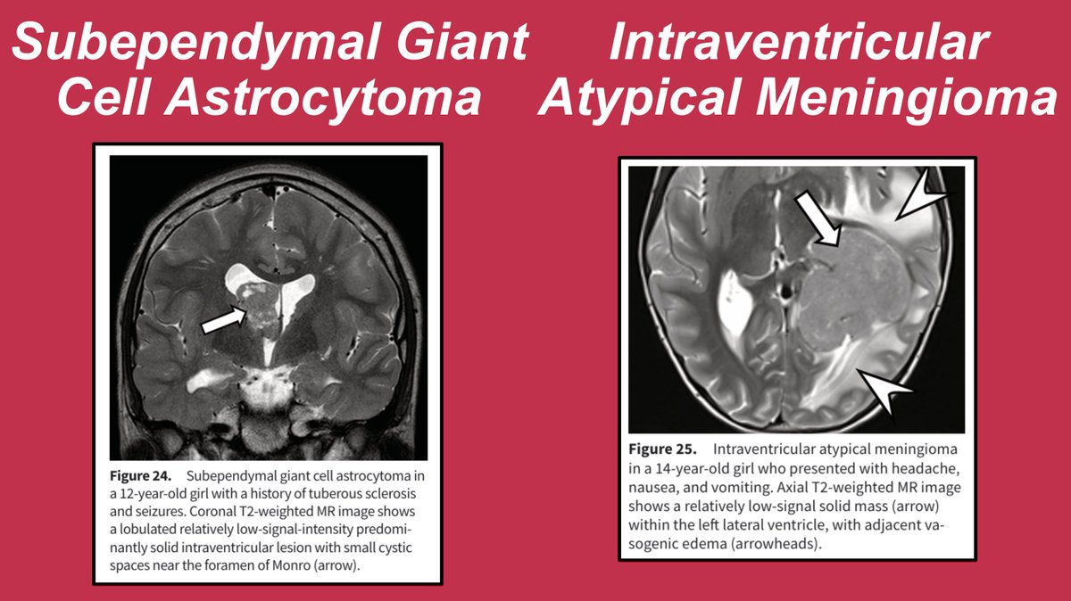 JamieClarkeRad's tweet photo. Now, let’s review a case of subependymal giant cell astrocytoma (Figure 24) and intraventricular atypical meningioma (Figure 25).
#RGphx https://t.co/Eom1DprfAg