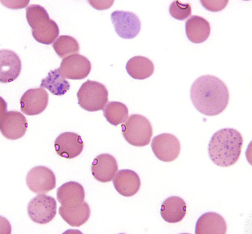 smbenlazar's tweet photo. Lead Poisoning and Basophilic Stippling - | ASH Image Bank | American Society of Hematology https://t.co/Nnd8m0qbuV #ASHImageBank https://t.co/W5gxG43nzd