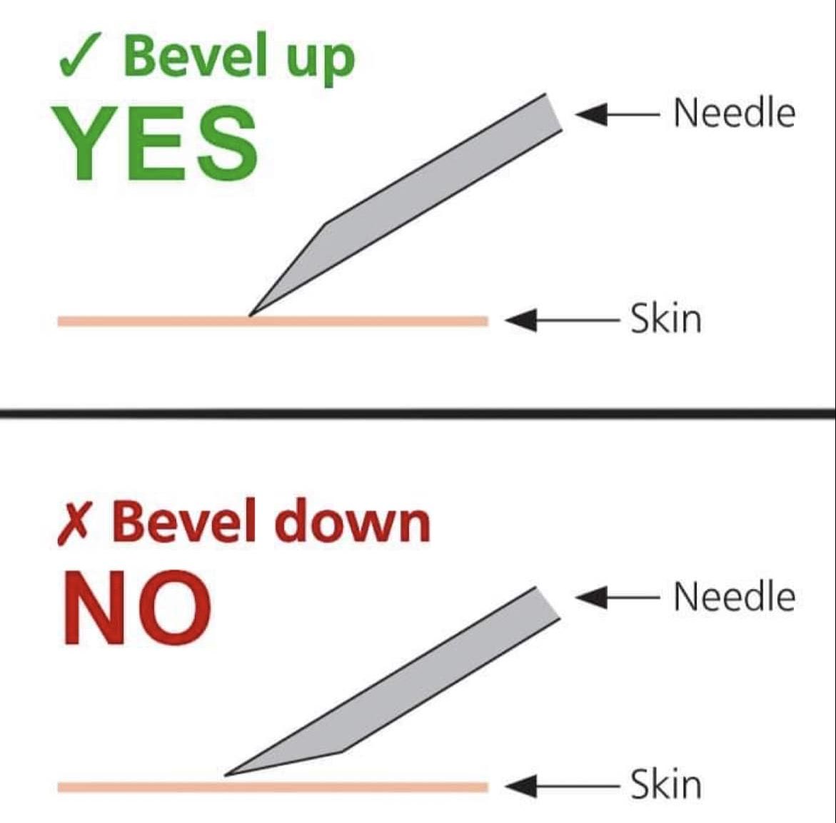 dxed_deer's tweet photo. some injection tips because you guys concern me 😭

you change needles every time you make a new puncture (vial or skin) because it dulls the bevel, increases risk of infection/inflammation, and drawing needles are often too large for injections. 
bevel should always face up!! https://t.co/ZSxYjqBnGZ