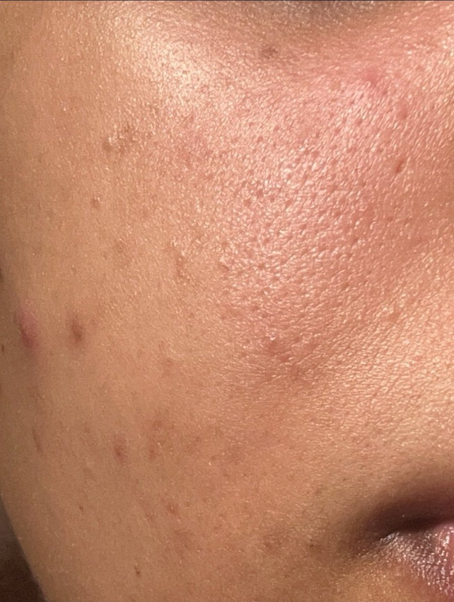 H_N00f's tweet photo. وش الحل مع مسامات الوجه اللي كذا 😩؟! https://t.co/jqyIlbqWQW
