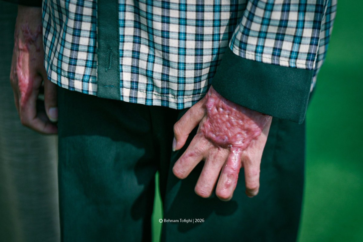GlobalNewsMontr's tweet photo. ⚡️The scars of a U.S. Tomahawk missile strike remain on the face and hands of Mohammad Sharafi, a second-grade student who survived the attack on Shajareh Tayyebeh School in Minab, southern Iran.

His sister, Zahra, was killed in the strike.

Photo: Behnam Tofighi https://t.co/XUnn5GsCLA