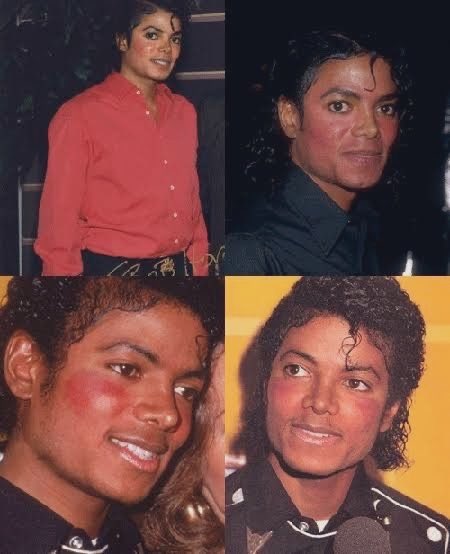 myapriest's tweet photo. lupus isn’t BOLDY listed on an autopsy, that’s very common. but the autopsy shows the structural damage and issues of his type of lupus. 2. michael also took plaquenil, which a type of medication for LUPUS.. he didn’t take that shit for fun. 3. he was diagnosed in early 1980s. https://t.co/jFF5naUY7D