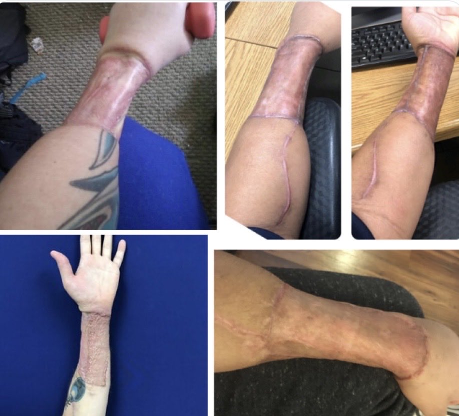 JulioRazona's tweet photo. Brazos de niñas transgénero después de someterse a una faloplastia, procedimiento que consiste en removerles la mayor parte de la piel y el músculo de su brazo para fabricarles un pene falso y que solo sirve de adorno.          Esos brazos sufrirán una atrofia funcional y dolor crónico a las víctimas de esas intervenciones satanicas. Dolencias que se sumarán a los padecimientos por la hormonizacion de por vida y las crisis psiquiátricas sobrevivientes.