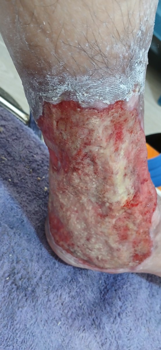 irincon77's tweet photo. @Supersalud Necesito ayuda porque @Audifarma_SA NO me entrega mis medicamentos pendientes, hace 2 meses no me dan apositos SuperAbsorbentes 20x30 y la ulcera grande esta llena de biofilm con mucho solor, llame a @EPSSaludTotal y me dijeron que ellos me ayudaban, pero no me han traido nada. https://t.co/rAF7oEXKQo