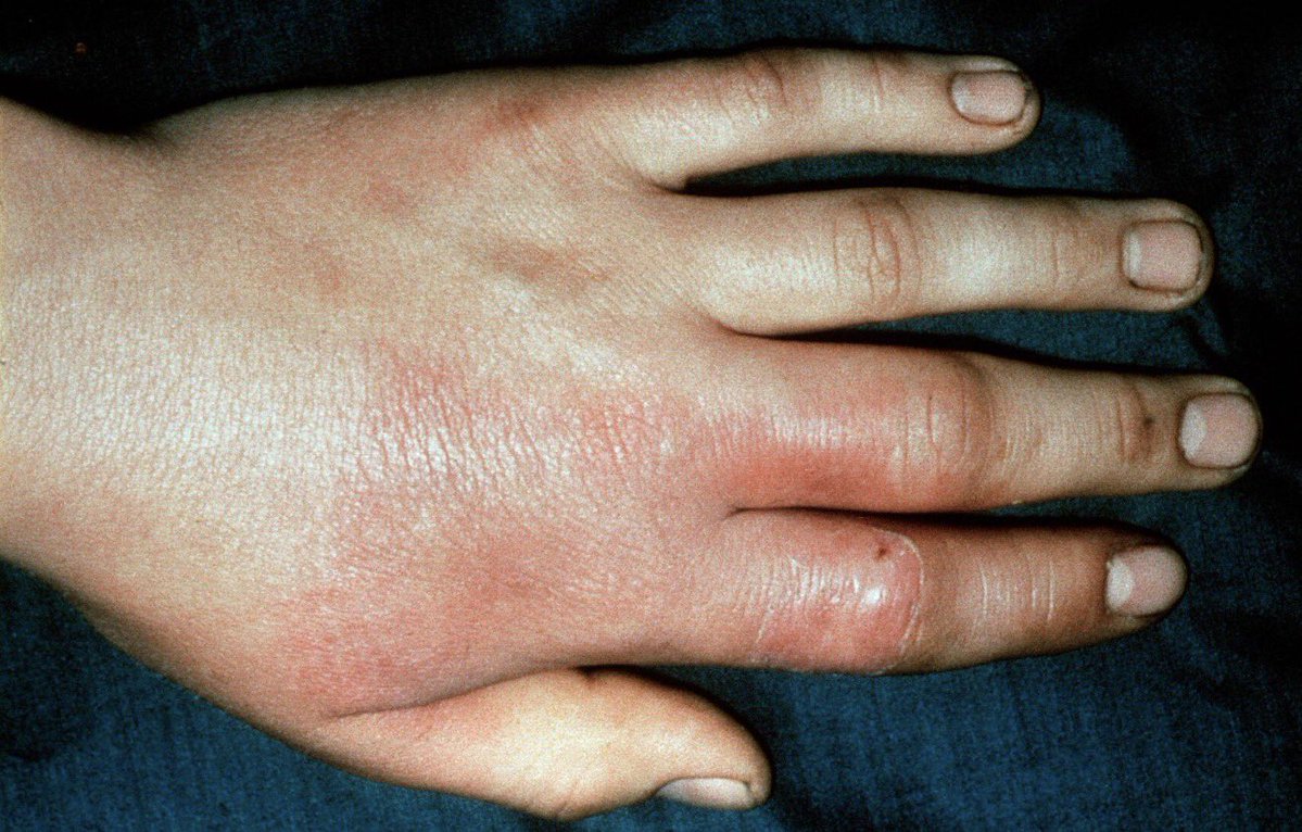 laboratorykh's tweet photo. Erysipelothrix rhusiopathiae

📌 من المعلومات المهمة في اختبار الهيئة SLLE

🥩 Erysipelothrix rhusiopathiae تُعرف بـ “بكتيريا الجزار”
لأنها ترتبط بالعدوى المهنية لدى الجزارين والعاملين مع الحيوانات والأسماك والأطباء البيطريين

🔬 ما هي؟
بكتيريا Gram-positive rod، غير مكوِّنة للأبواغ، وتتميز بأنها Non-motile & Catalase negative

🦠 أهم الأنواع سريريًا:
E. rhusiopathiae

🐷 في الحيوانات:
تسبب Erysipelas، خصوصًا في الخنازير.

👨‍⚕️ في الإنسان:
تسبب Erysipeloid، وهي عدوى جلدية موضعية تحدث غالبًا بعد دخول البكتيريا عبر جرح أو خدش بالجلد أثناء التعامل مع الحيوانات أو الأسماك واللحوم المصابة

⭐ احفظها للاختبار:

Butcher + Animal/Fish exposure + Skin lesion → Erysipelothrix rhusiopathiae

Gram-positive rod + Non-motile + Catalase negative 🧫

#مختبرات_طبيه
#microbiology
 #bacteria