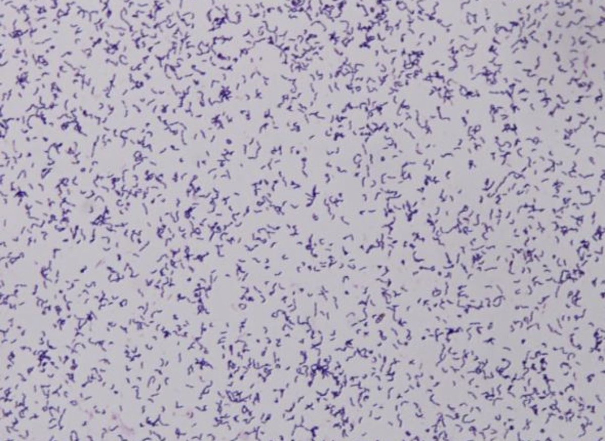 laboratorykh's tweet photo. Erysipelothrix rhusiopathiae

📌 من المعلومات المهمة في اختبار الهيئة SLLE

🥩 Erysipelothrix rhusiopathiae تُعرف بـ “بكتيريا الجزار”
لأنها ترتبط بالعدوى المهنية لدى الجزارين والعاملين مع الحيوانات والأسماك والأطباء البيطريين

🔬 ما هي؟
بكتيريا Gram-positive rod، غير مكوِّنة للأبواغ، وتتميز بأنها Non-motile & Catalase negative

🦠 أهم الأنواع سريريًا:
E. rhusiopathiae

🐷 في الحيوانات:
تسبب Erysipelas، خصوصًا في الخنازير.

👨‍⚕️ في الإنسان:
تسبب Erysipeloid، وهي عدوى جلدية موضعية تحدث غالبًا بعد دخول البكتيريا عبر جرح أو خدش بالجلد أثناء التعامل مع الحيوانات أو الأسماك واللحوم المصابة

⭐ احفظها للاختبار:

Butcher + Animal/Fish exposure + Skin lesion → Erysipelothrix rhusiopathiae

Gram-positive rod + Non-motile + Catalase negative 🧫

#مختبرات_طبيه
#microbiology
 #bacteria