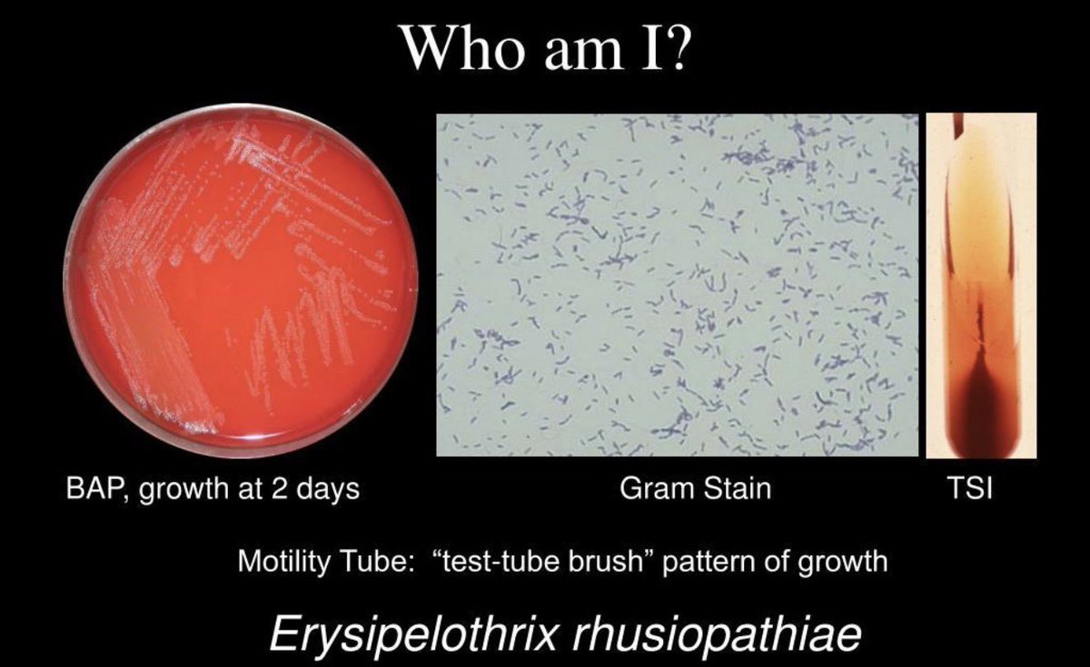 laboratorykh's tweet photo. Erysipelothrix rhusiopathiae

📌 من المعلومات المهمة في اختبار الهيئة SLLE

🥩 Erysipelothrix rhusiopathiae تُعرف بـ “بكتيريا الجزار”
لأنها ترتبط بالعدوى المهنية لدى الجزارين والعاملين مع الحيوانات والأسماك والأطباء البيطريين

🔬 ما هي؟
بكتيريا Gram-positive rod، غير مكوِّنة للأبواغ، وتتميز بأنها Non-motile & Catalase negative

🦠 أهم الأنواع سريريًا:
E. rhusiopathiae

🐷 في الحيوانات:
تسبب Erysipelas، خصوصًا في الخنازير.

👨‍⚕️ في الإنسان:
تسبب Erysipeloid، وهي عدوى جلدية موضعية تحدث غالبًا بعد دخول البكتيريا عبر جرح أو خدش بالجلد أثناء التعامل مع الحيوانات أو الأسماك واللحوم المصابة

⭐ احفظها للاختبار:

Butcher + Animal/Fish exposure + Skin lesion → Erysipelothrix rhusiopathiae

Gram-positive rod + Non-motile + Catalase negative 🧫

#مختبرات_طبيه
#microbiology
 #bacteria