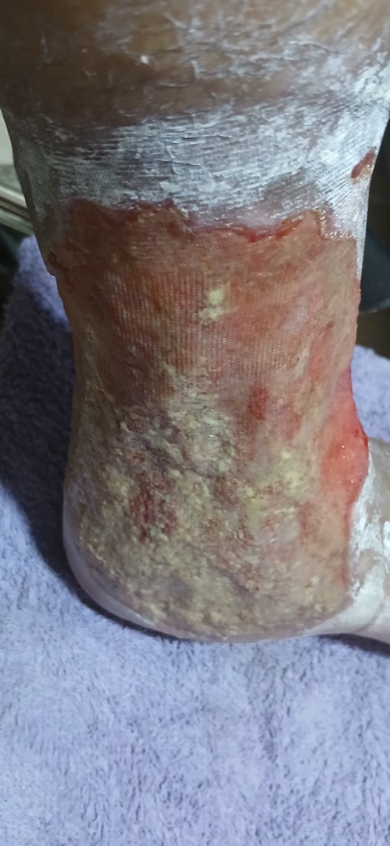 irincon77's tweet photo. @EPSSaludTotal @Supersalud Necesito ayuda pues @Audifarma_SA NO me entrega medicamentos pendientes hace 2 meses, no me dan apositos SuperAbsorbentes 20x30cm y la ulcera grande esta con biofilm y mucho dolor.
Llame a la linea de pendientes, dijeron q me ayudaban y no han enviado ni 1 apósito https://t.co/ikVSLOpwZp
