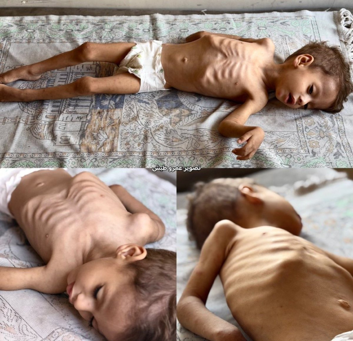 daktilock's tweet photo. Filistin'de yaşanan kıtlık nedeniyle bir çocuğun aşırı zayıflamış hali görüntülendi. https://t.co/SWjIlAi3yJ