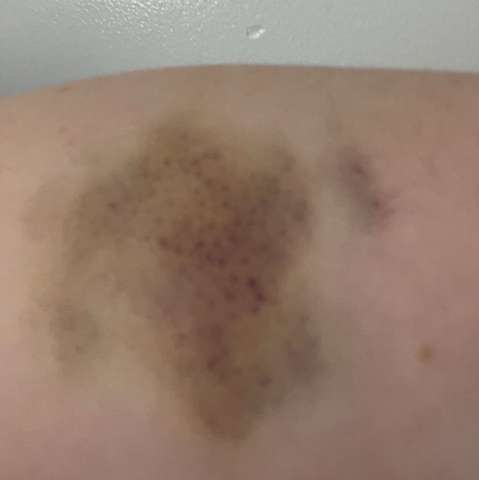 ace3backup's tweet photo. i miss these bruises #bruisetwt #shrtwt ai makeup sfx https://t.co/Sfac2qCpR9
