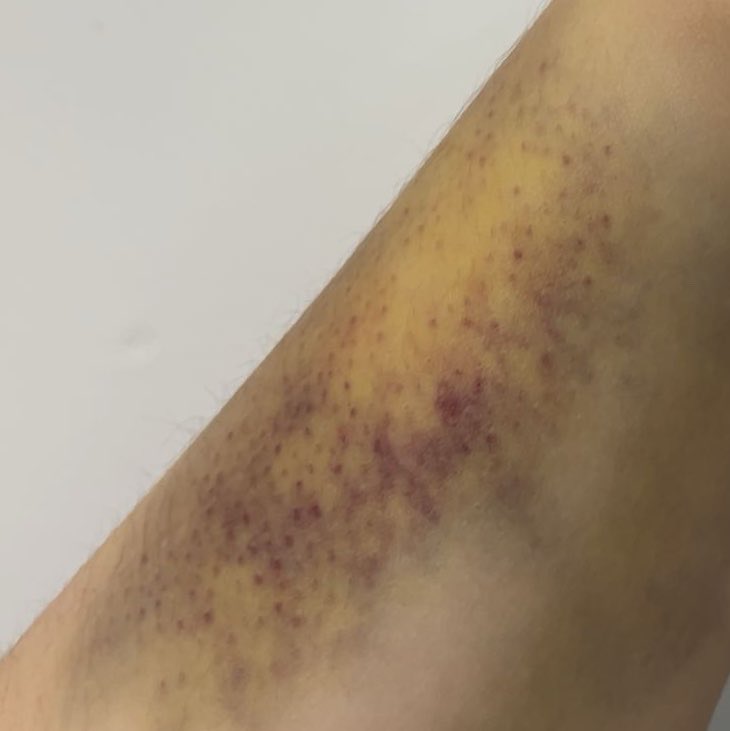 ace3backup's tweet photo. i miss these bruises #bruisetwt #shrtwt ai makeup sfx https://t.co/Sfac2qCpR9