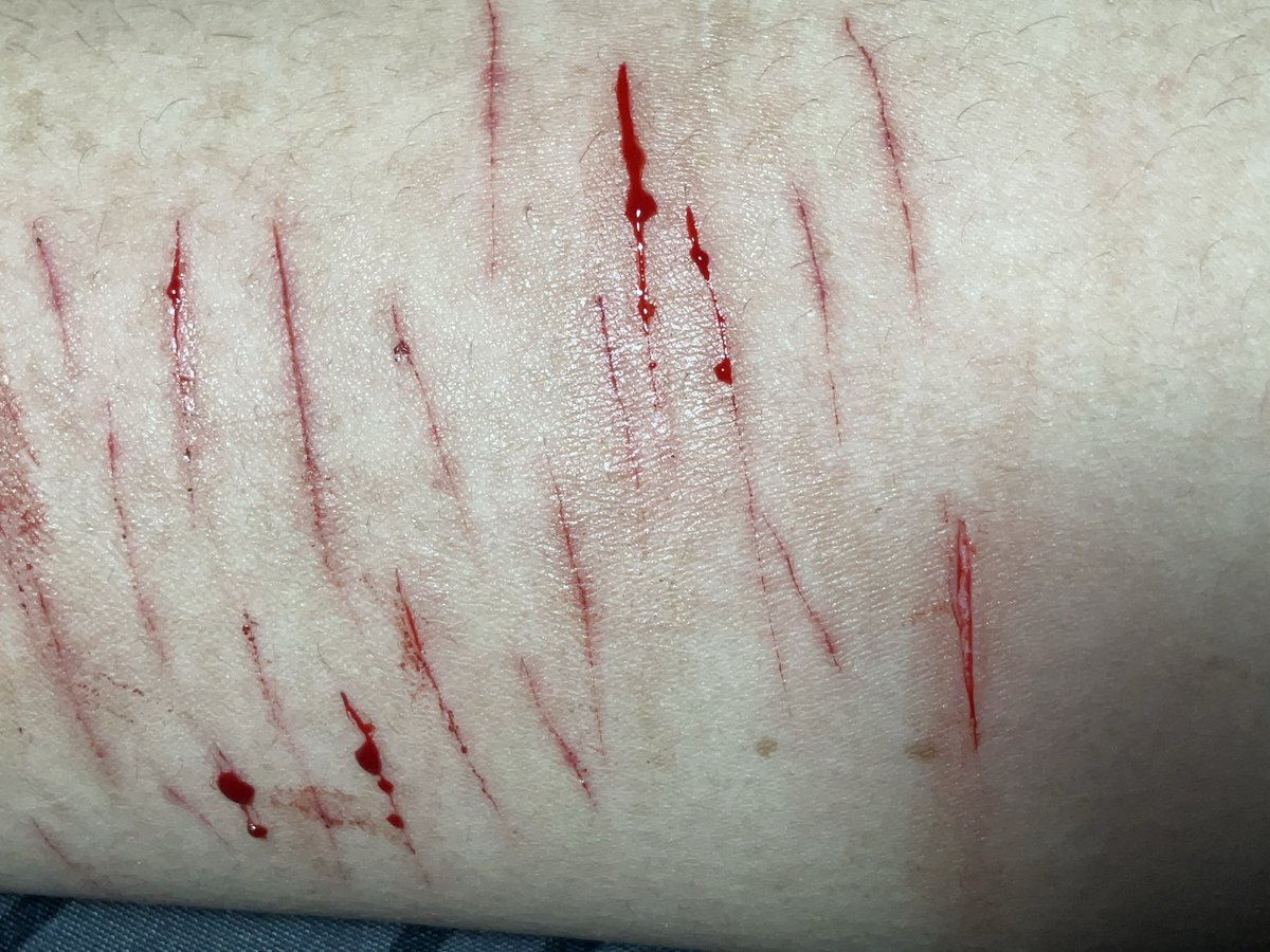 happiesturethan's tweet photo. FAKE REALISTIC SFX MAKEUP ENHANCED WITH AI, ok?

Last week!!OKAY #shtwt #cuttwt #slittwt #sh #cut #slit #fake #makeup #ouchietwt https://t.co/6quJatxyXa