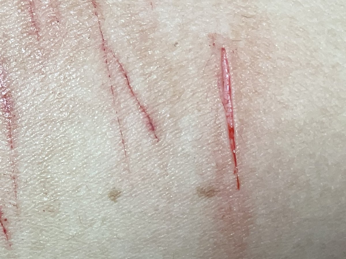 happiesturethan's tweet photo. FAKE REALISTIC SFX MAKEUP ENHANCED WITH AI, ok?

Last week!!OKAY #shtwt #cuttwt #slittwt #sh #cut #slit #fake #makeup #ouchietwt https://t.co/6quJatxyXa