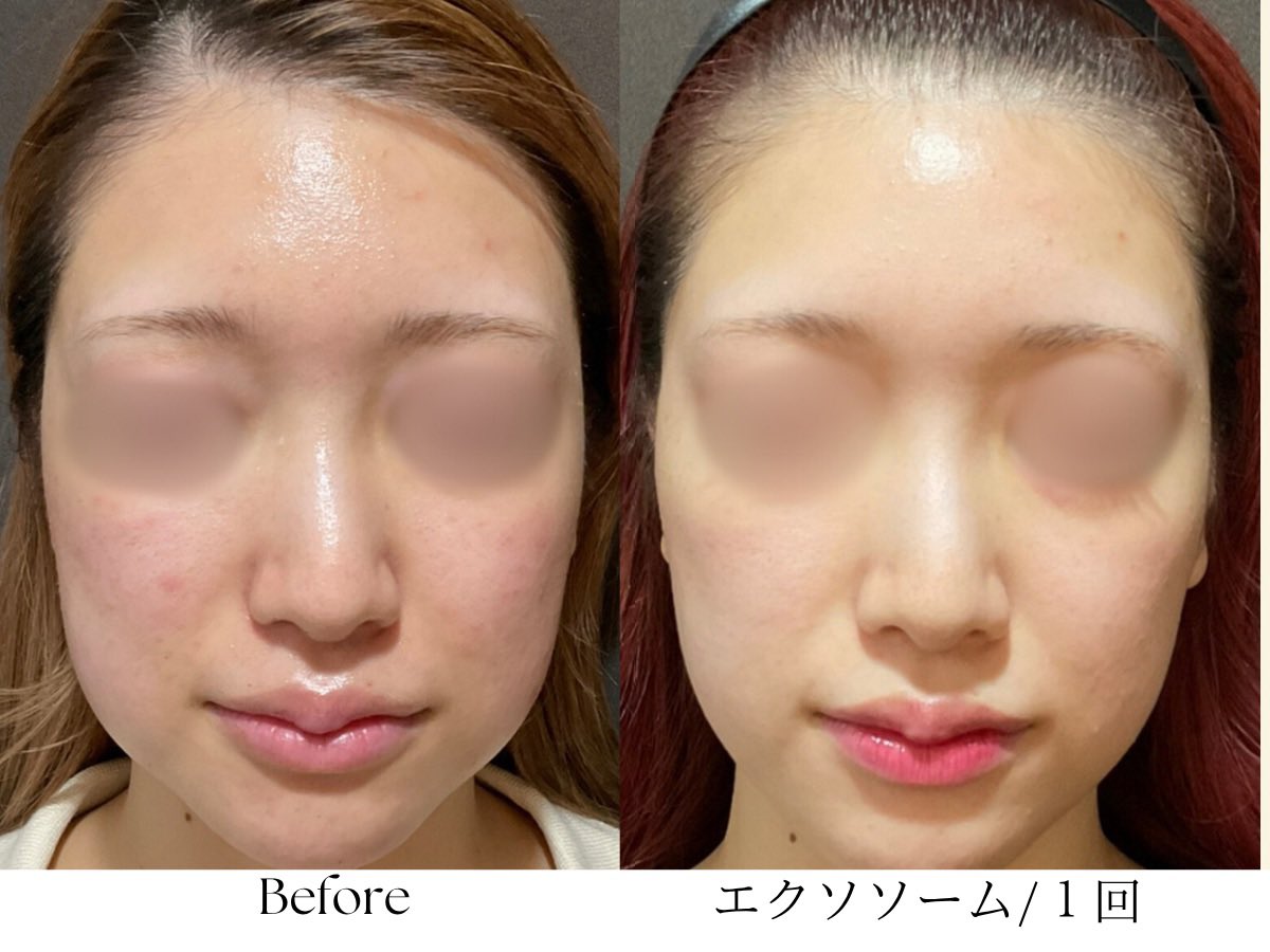 bebeaura_salon's tweet photo. 秋の揺らぎ肌は、9月中にリセットを🔄
ただのピーリングではなく『ダメージを受けた肌を排出』し肌再生ケア！

☑︎2週間後、肌がツルッと✨
☑︎今あるニキビやニキビ跡の改善
☑︎毛穴やくすみケア

夏の紫外線ダメージも季節の変わり目の揺らぎも【エクソソームフェイシャル】で肌リセットを🤍 https://t.co/YiKyKU4Z5F