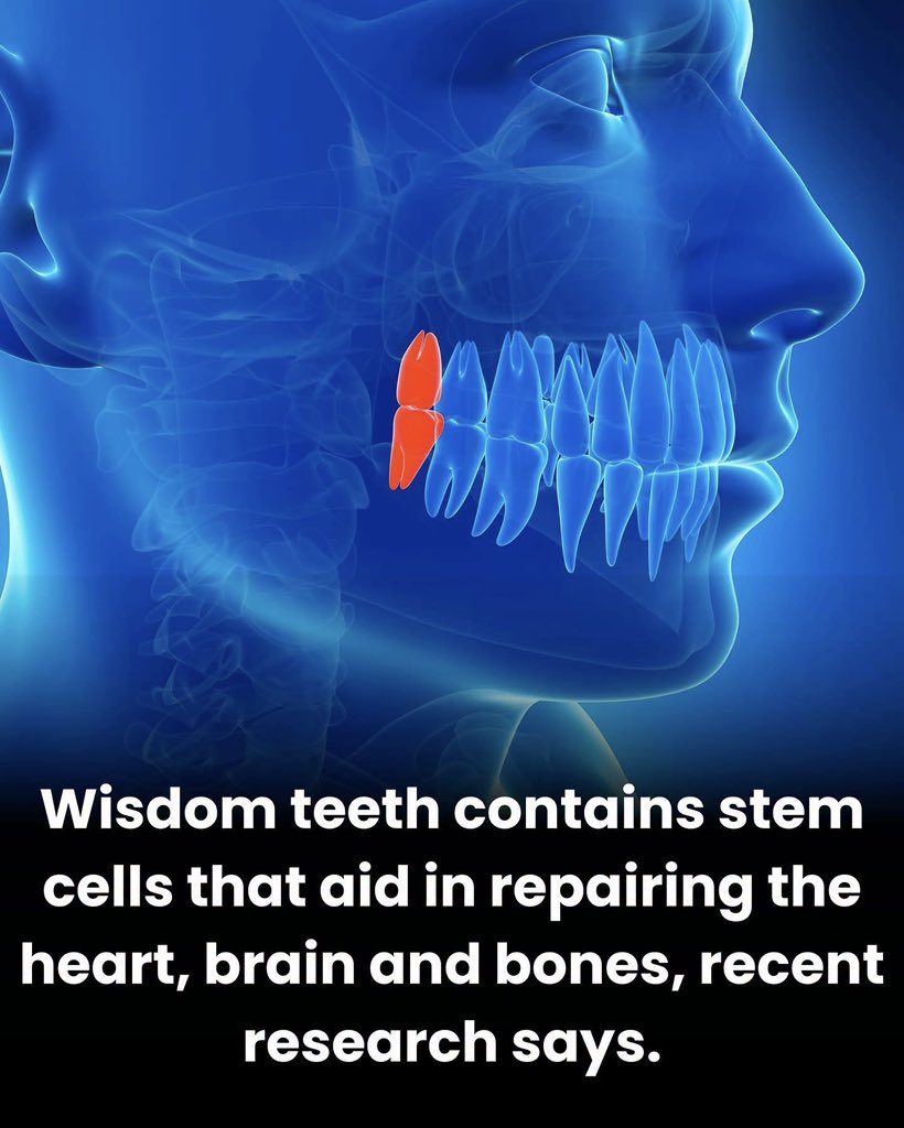 SmartScience's tweet photo. Wisdom teeth may be more biologically valuable than they look. Inside their soft dental pulp is a population of dental pulp stem cells capable of developing into several specialized cell types.

These cells are especially interesting because wisdom teeth are routinely extracted and discarded, making them a relatively accessible source of a person’s own stem cells without collecting them from bone marrow.

Researchers have already shown strong potential for bone regeneration. In laboratory and animal studies, DPSCs can become bone-forming cells, promote blood-vessel formation and help regenerate damaged bone when combined with suitable biological scaffolds.

Their origin makes them particularly interesting for neuroscience too. Dental pulp stem cells arise from neural-crest tissue during development and can display neuron-like characteristics under laboratory conditions. Researchers are studying their ability to support nerve growth, reduce inflammation and release molecules that protect damaged neural tissue.

Heart research has also explored DPSCs and the substances they release for repairing damage after cardiac injury. Much of the apparent benefit appears to come not simply from turning into heart cells, but from releasing signaling molecules that encourage blood-vessel growth, regulate inflammation and support surrounding tissue.

But these applications are still largely experimental. There is not currently an established treatment where doctors take your wisdom tooth and use its stem cells to routinely repair your brain, heart or bones. Most evidence outside dentistry remains preclinical.

So throwing away a wisdom tooth may technically mean throwing away an unusual source of stem cells—but turning those cells into reliable treatments for major organ damage is the challenge scientists are still working to solve.

Source: PubMed; Stem Cells International; BMC Oral Health