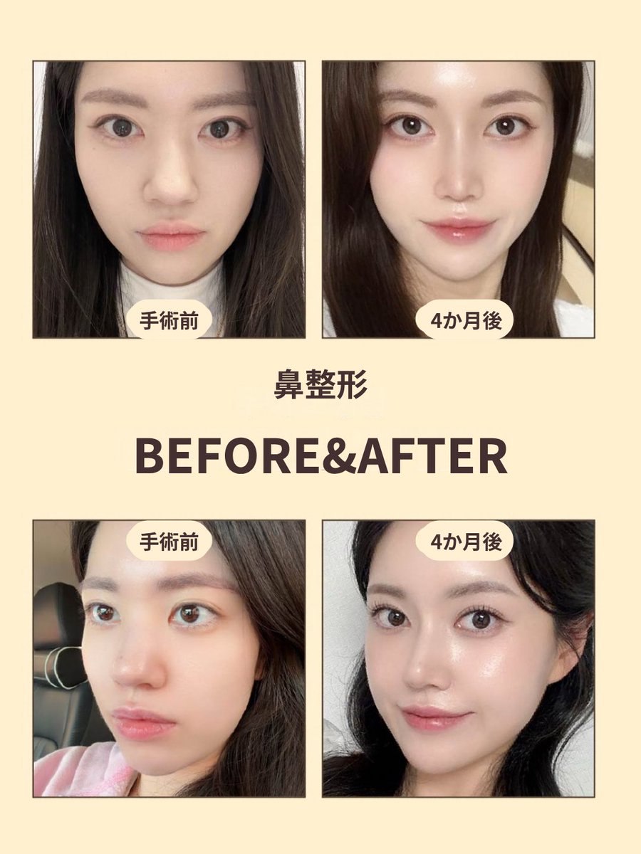 mooips_jp's tweet photo. 鼻整形 Before & After 👃✨

正面から見ても、横から見ても
すっきりと洗練された鼻ラインに🤍
鼻先まで自然に整えることで、
お顔全体がより立体的で華やかな印象へ。

📸 手術前 → 4ヶ月後
「派手すぎないけど、しっかり変化が欲しい」
そんな方にもおすすめです✨

韓国で鼻整形をお考えの方は
お気軽にお問い合わせください💌