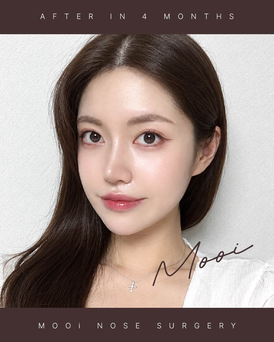 mooips_jp's tweet photo. 鼻整形 Before & After 👃✨

正面から見ても、横から見ても
すっきりと洗練された鼻ラインに🤍
鼻先まで自然に整えることで、
お顔全体がより立体的で華やかな印象へ。

📸 手術前 → 4ヶ月後
「派手すぎないけど、しっかり変化が欲しい」
そんな方にもおすすめです✨

韓国で鼻整形をお考えの方は
お気軽にお問い合わせください💌