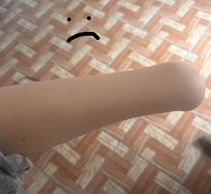 ponyfilica's tweet photo. Me amputaron la mano https://t.co/RAdr2A5NAf