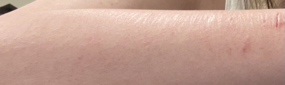 ideletemyaccoun's tweet photo. baby bean maybe and some healed catscratches shinin in deh light ~~~ do u see how sick i am??????????????? https://t.co/iP7fu9YxVG