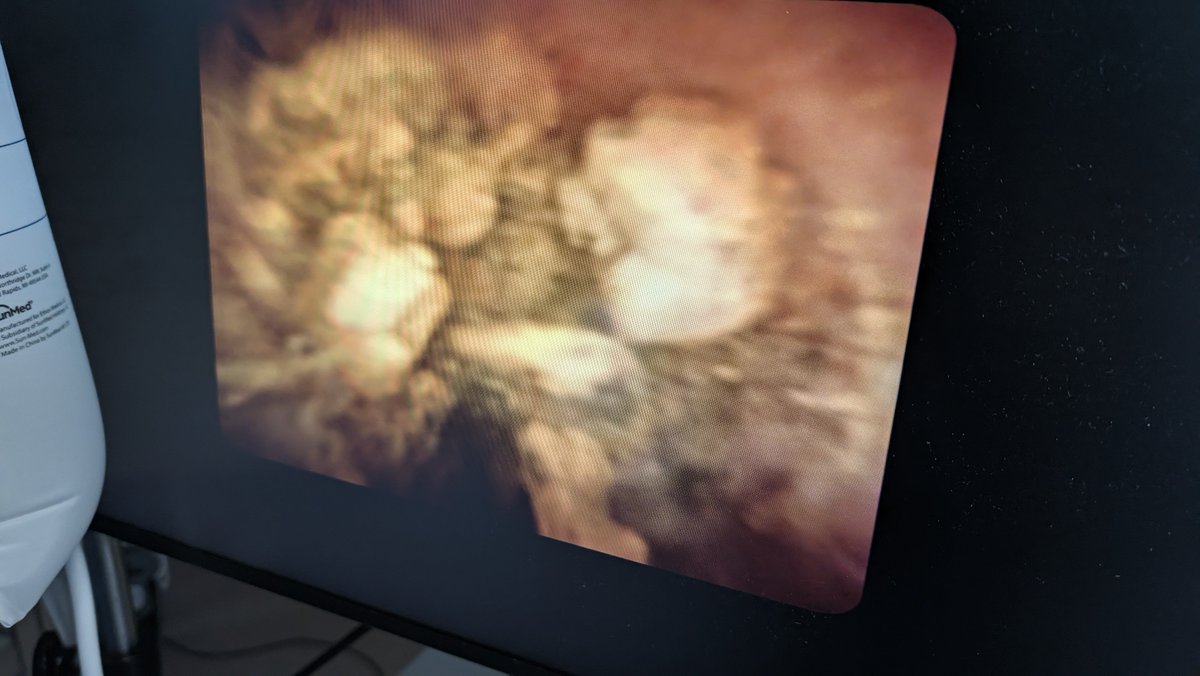 Robo_HPB's tweet photo. EHL lithotripsy is extremely helpful to breakup stones which can then be easily pushed through to the duodenum. I like having a wire across ampulla and having dilated it first then flush/push through/pull back/flush to clear debris. Pushing Antegrade balloon might also work? https://t.co/Unbnx1AaXK