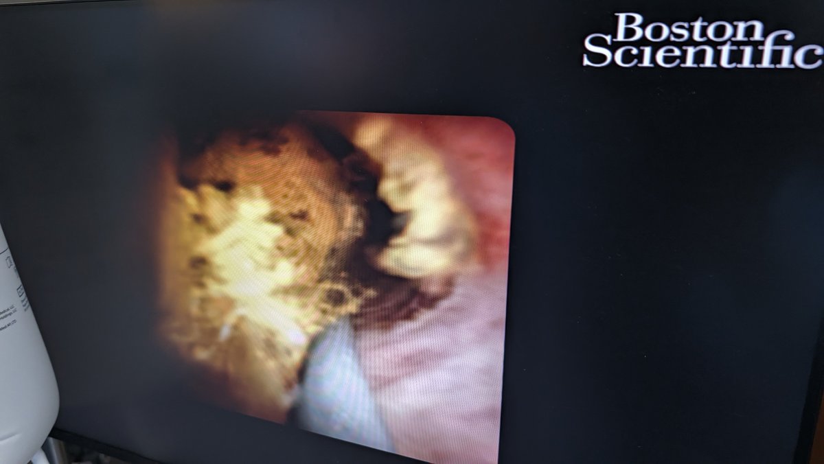 Robo_HPB's tweet photo. EHL lithotripsy is extremely helpful to breakup stones which can then be easily pushed through to the duodenum. I like having a wire across ampulla and having dilated it first then flush/push through/pull back/flush to clear debris. Pushing Antegrade balloon might also work? https://t.co/Unbnx1AaXK