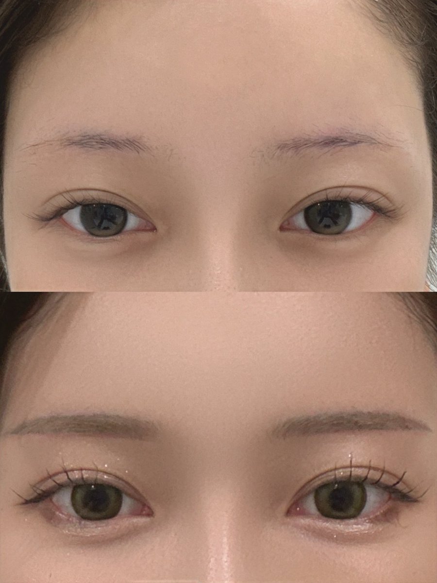 pude__chige_'s tweet photo. 元々眉毛薄い+眉下切開で半分くらい眉毛刈り取られたのとで、スッピンだとほぼマロ眉状態だったんだけど( ꒪• ·̫ •꒪)
傷も落ち着いてきたから眉アートしてきた😾💞
院長先生が顔のバランス見ながら理想通りの眉にデザインしてくれました💛
スッピンでも眉毛あるの嬉しいし、メイクが楽すぎる😭✨️
ありがとうございました🫶
@Riabeauty_kr