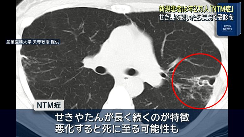 yuruhuwa_kdenpa's tweet photo. 厚労省は明日からNTM症の啓発週間を開始

長く続く咳って市井では100日咳のイメージの方が定着した感あるな

臨床現場でドクターがどういうイメージ感を持ってるかが気になる https://t.co/k1Mgrmk8uV
