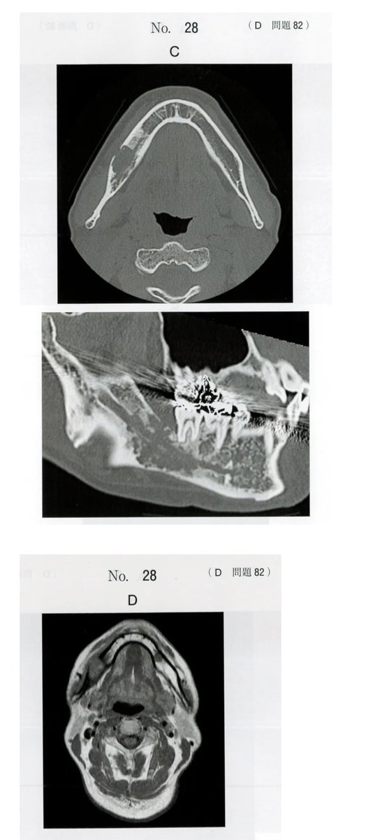 DentAce_119's tweet photo. 歯科医師国家試験119D82
これとか本番解いてて本当に萎えた。
解答する難易度自体は高くないんだけど、
3分で解くべき臨実問題なのに1問で読むべき画像が8種類。
最後のD冊子の終盤82問目にして、意図的に問題を難しくしようとしている魂胆が透けて見えて最近の歯科国試は気持ち悪いなぁと思った。 https://t.co/Tcr60tvqlL