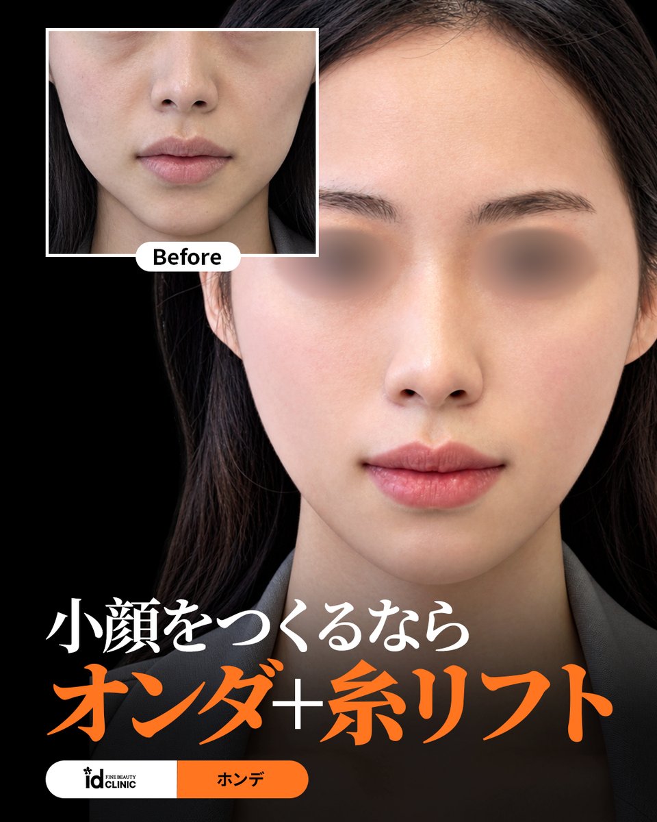 idclinicjp's tweet photo. 糸リフト+オンダリフト｜小顔をつくるなら

🧡リフティングならidClinic弘大🧡

✔ レーザー×糸リフトで維持力ＵＰ
✔ 引き上げで中顔短縮+小顔効果
✔ 時間が経つにつれてコラーゲンへ変化

✨ 多様なリフティング方法をご提案
✨ 眺めの良い高層階での施術で贅沢美容day
✨ 日本語対応可

📍 id Clinic 弘大院
📞 ご予約・お問い合わせは、こちら
https://t.co/vibZORB0mE

＃リフティング #韓国美容 #中顔面短縮 #弘大