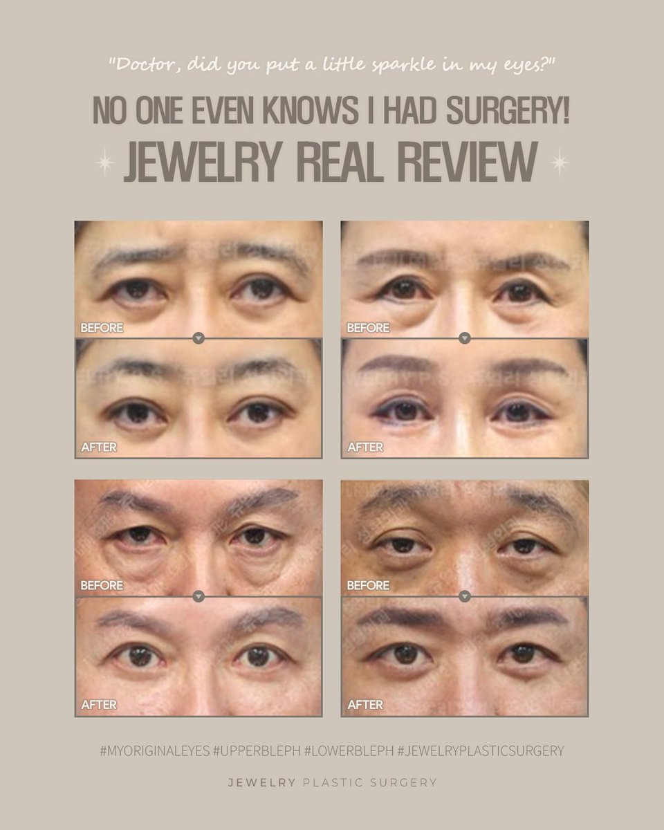jewelrypsglobal's tweet photo. TIME-REVERSE
No more dark undereyes! Find out how, at Jewelry💎
Safe, natural result. 17 years of trust.
- Whatsapp : +82 10-7446-2712
#blepharoplasty #eyebrowlift #foreheadlift #JewelryPlasticSurgery #JewelryPS #KoreaPlasticSurgery #SeoulPlasticSurgery https://t.co/syQcHGgdIi