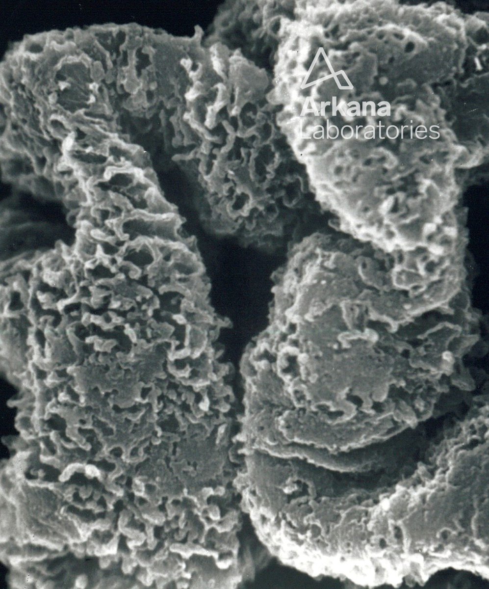 arkanalabs's tweet photo. Here is today’s #eyeSCANdy! Acellular scanning EM from a biopsy with membranous glomerulonephritis showing depressions and larger "craters" along the subepithelial aspect of the basement membrane.
Photo courtesy of Dr. Stephen Bonsib. #renal #pathology #kidneypath https://t.co/IXnAnoi3E3