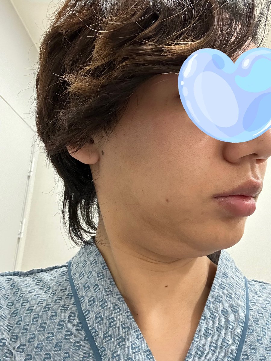 GyaJya's tweet photo. ペリカン+ネックリフト+スマスリフト
経過7ヶ月　※ノーマルカメラ

※術後、ダイエットで4キロ落ちてます

#ペリカン手術　#ネックリフト　#ミニ切開リフト https://t.co/8RqAa12heD