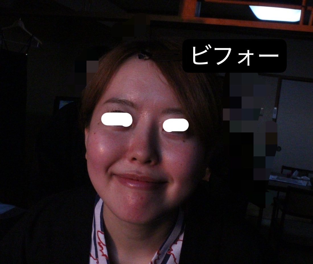 omochi57842411's tweet photo. 輪郭で人生変わった❕❕❕

骨切りと脂肪吸引と切開リフトとその他諸々✌︎(　˙-˙　)✌︎💸💸

1枚目Before 
2~4枚目now https://t.co/o4YYWW9pSB