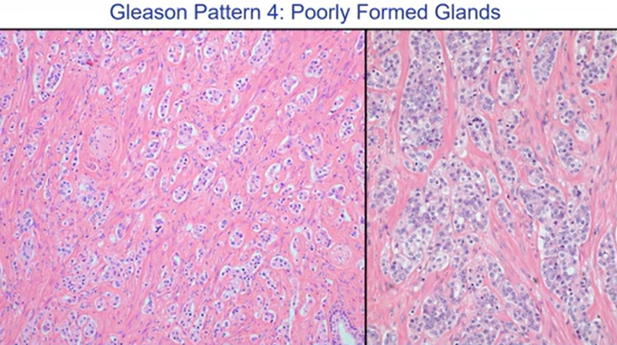 Janiranavarro's tweet photo. Gleason Pattern 4: Poorly formed glands

None of these glands have lumina, this is not tangential section .
Probably you could think this is grade 5. Do not call it grade 5
Across all clinical outcome groups, this morphologic pattern is NOT associated with metastatic potential.

Dr. McKenney Prostatic Adenocarcinoma Grading: 2026 Update #USCAP #pathX #pathology