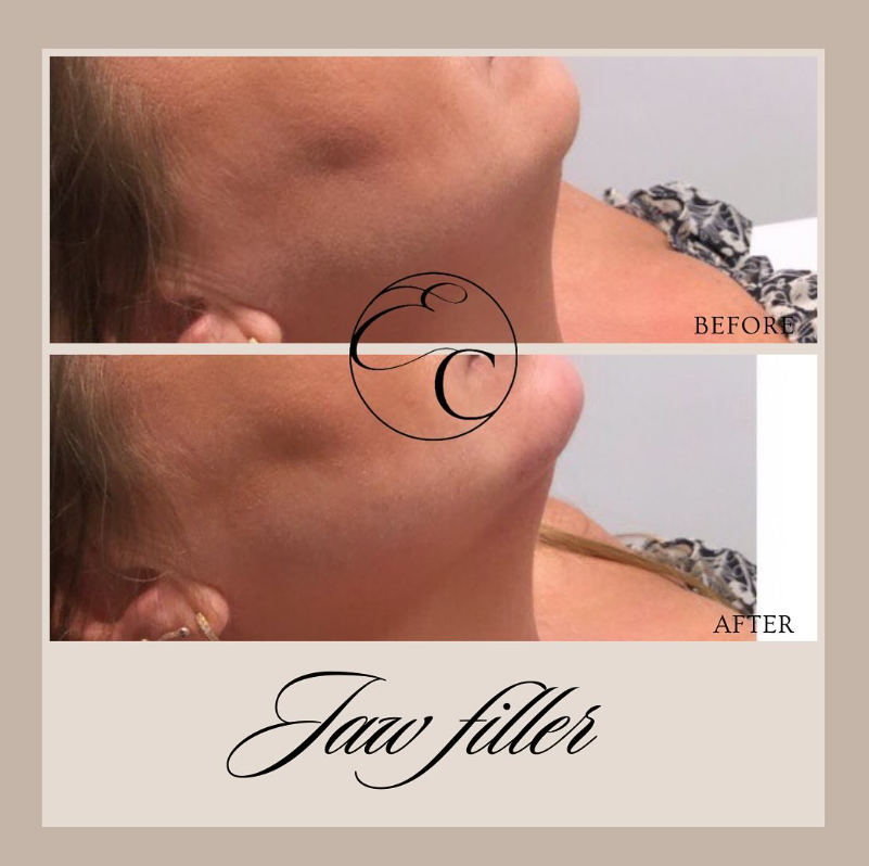 EnhanceClinicBe's tweet photo. 𝐉𝐚𝐰 𝐟𝐢𝐥𝐥𝐞𝐫💉

3ML filler in the jaw &amp; chin for this lovely lady.
Visit: https://t.co/kaVMRjnfEz
🕣 Appointment time: 20 min
🤕 Downtime: Bit of swelling and bruising can accur, allow two weeks to fully settle.

#enhanceclinic #aesthetic #ghent #botox #beauty #fillers https://t.co/cRIz0L20g8