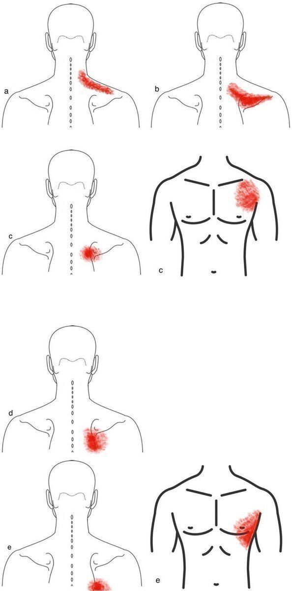 MoAImam's tweet photo. Not all shoulder pain comes from the shoulder.

These are referral maps. Pain arising in the cervical spine and the periscapular soft tissues does not stay where it starts. It refers across the trapezius, over the scapula, and in some patterns onto the anterior chest wall.

Two practical consequences.

A patient pointing to the top of the shoulder is not necessarily describing a rotator cuff. Cervical and myofascial sources produce a very similar map, and the examination has to separate them before imaging is asked to.

And a normal shoulder MRI in a patient with convincing shoulder pain is not a dead end. It is a prompt to examine the neck.

If the pain does not change with shoulder movement, stop moving the shoulder.