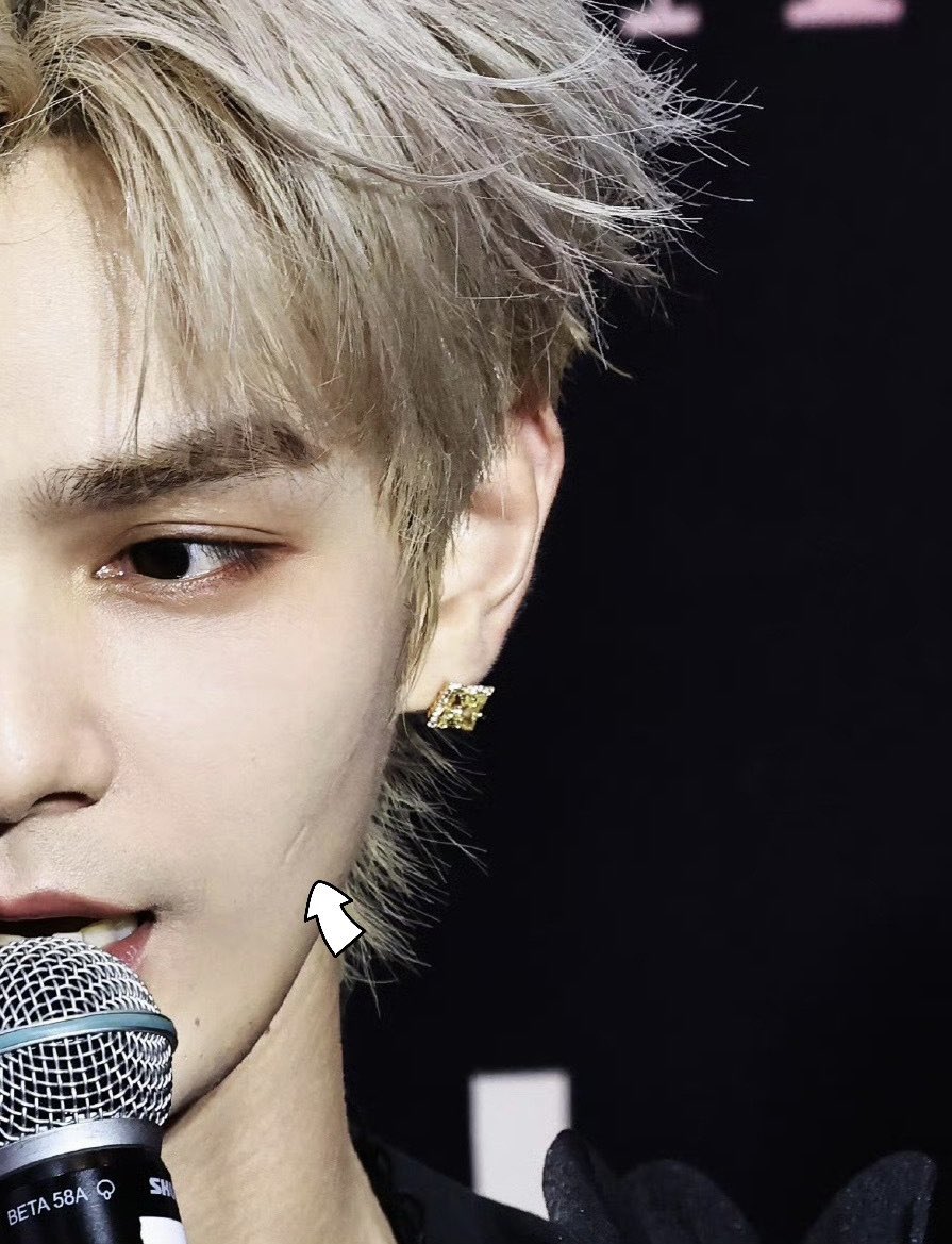 0_76p's tweet photo. zhaozhao got this face scratch at a friend’s house he got so hyped the chair completely broke and a piece flew off and cut his face xixi was genuinely worried for him like “you actually look handsome but this is really painful” 🥺 meanwhile zz was just happy cos the scar makes him look more masculine and hotter and seeing that xixi has a scar too made me understand why he sees it that way