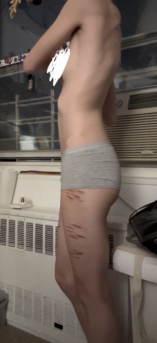 YulasTired's tweet photo. warning bc!! 
fake scars and body 
cw:100lbs
gw:90lbs
ugw:80lbs
#edrtwt https://t.co/VehPncZSOP