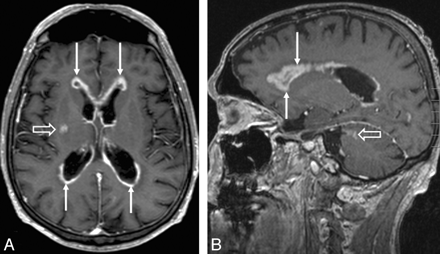 DocNavarrow's tweet photo. 🧠Diffuse subependymal enhancement tracks along the ventricular walls on postcontrast MRI. 

🤔Which diagnosis should this pattern bring to mind? https://t.co/BORlkp1kPf