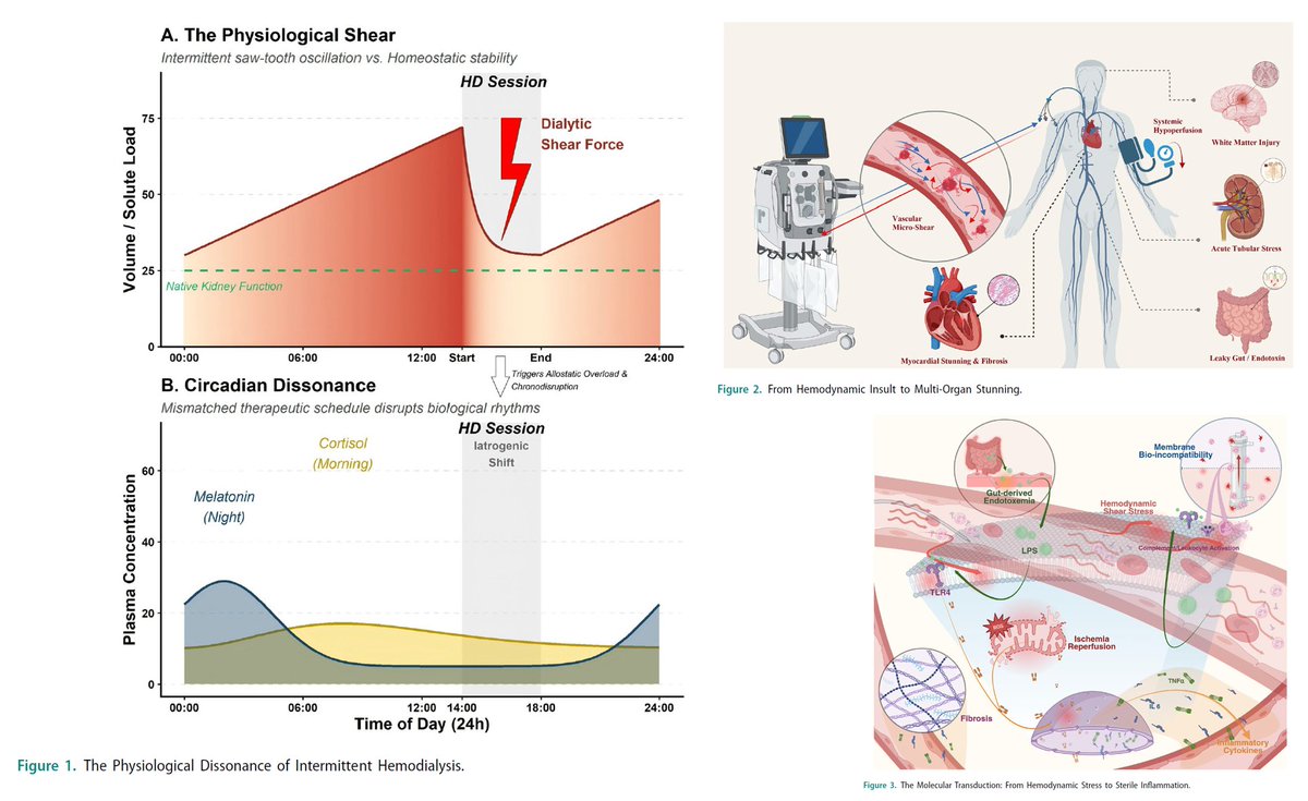 EDL1976's tweet photo. Nuevo paradigma: El Síndrome de Estrés Dialítico Repetitivo desafía la visión toxico-céntrica. La hemodiálisis intermitente causa una carga hemodinámica cíclica, induciendo shock microcirculatorio y aturdimiento multiorgánico. Renal Failure. DOI:10.1080/0886022X.2026.2727734 https://t.co/TsaHmhCQJO
